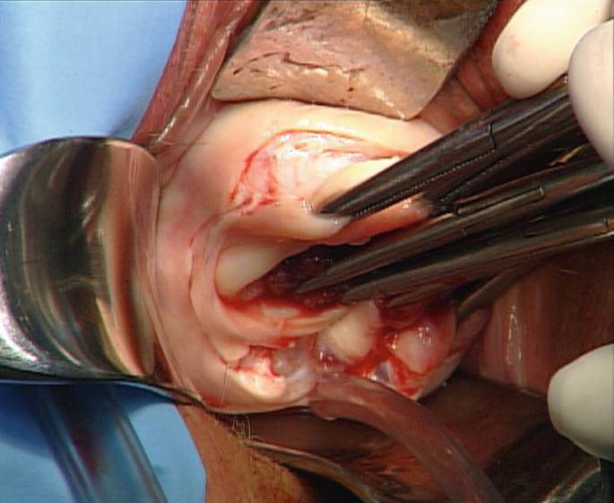 عوارض احتمالی لاپاراسکوپی واژن