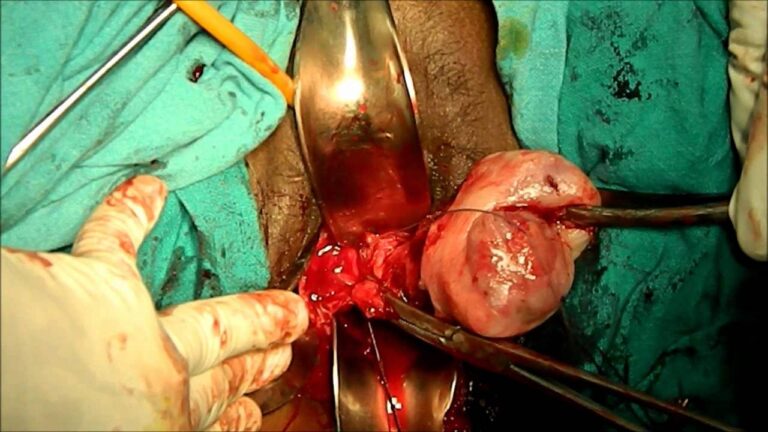 لاپاراسکوپی واژن