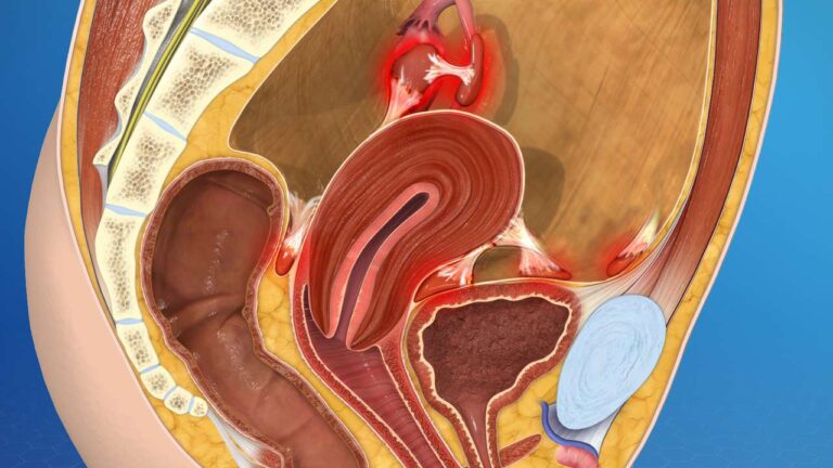 آندومتریوز چیست
