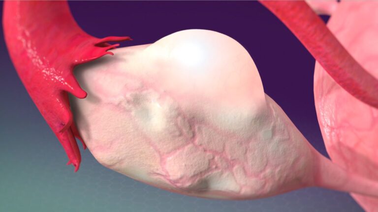 کیست ۷ سانتی تخمدان