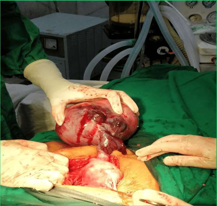 کیست درموئید