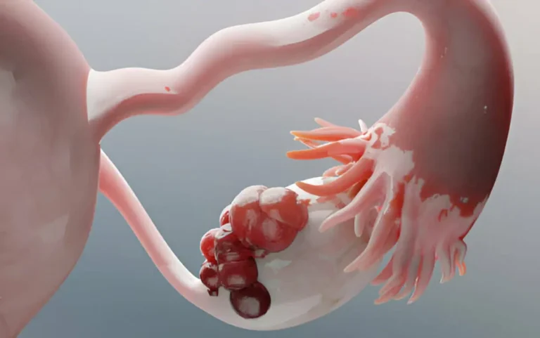 اندازه کیست تخمدان